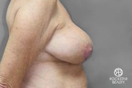 Breast Reduction: Patient 2 - After 3