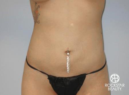 SmartLipo®: Patient 3 - After Image 1