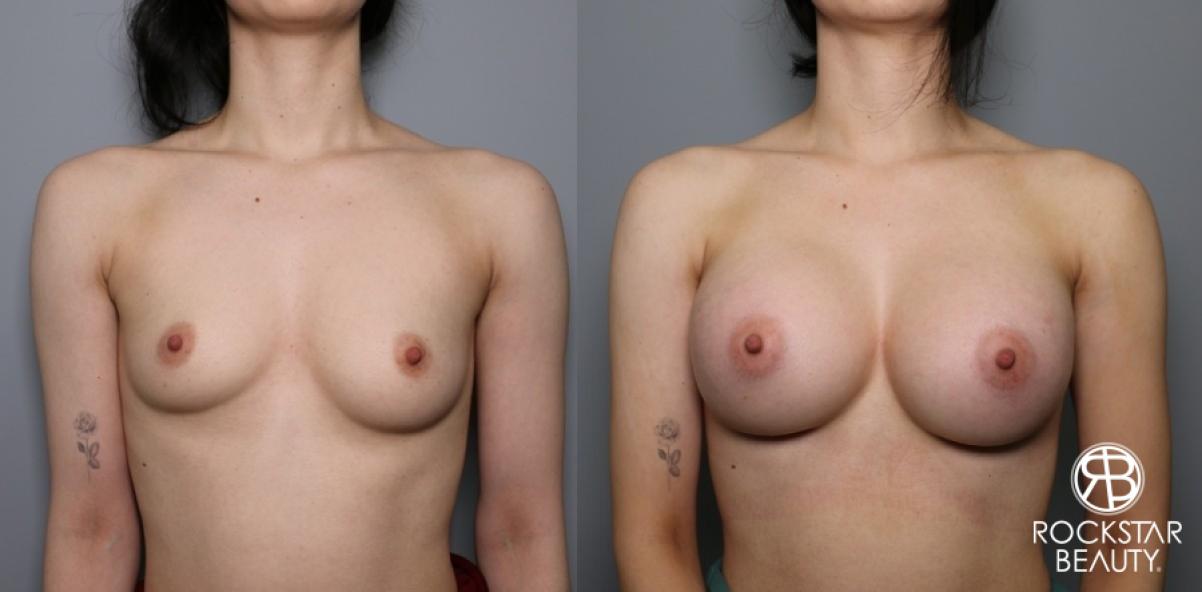 Breast Augmentation: Patient 17 - Before and After 1
