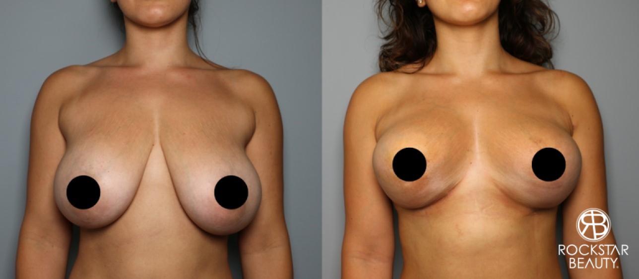 Breast Lift: Patient 6 - Before and After 1