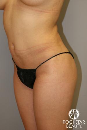 Liposuction: Patient 14 - Before Image 1