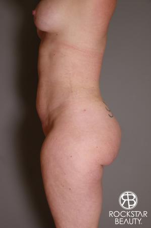 Brazilian Butt Lift: Patient 7 - After Image 5