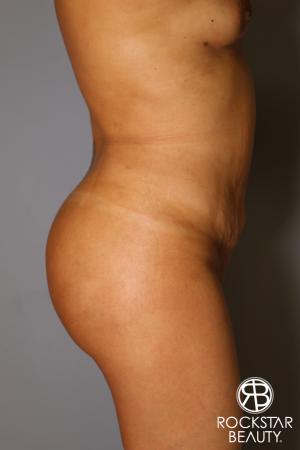 Brazilian Butt Lift: Patient 12 - After Image 3