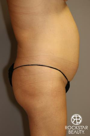 Tummy Tuck: Patient 1 - Before Image 3