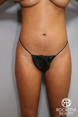 Liposuction: Patient 1 - Before Image 1