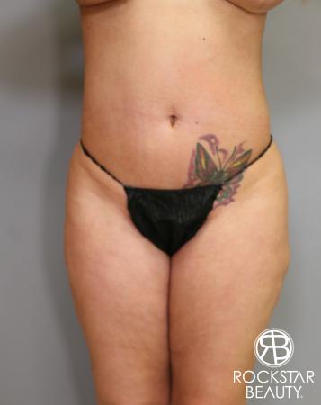 Liposuction: Patient 7 - Before Image 1