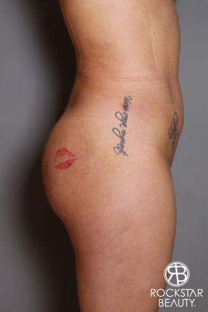 Brazilian Butt Lift: Patient 17 - After Image 4