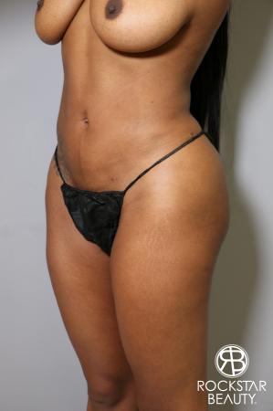 Liposuction: Patient 18 - After Image 2