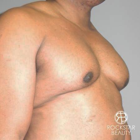 Gynecomastia: Patient 1 - Before 2