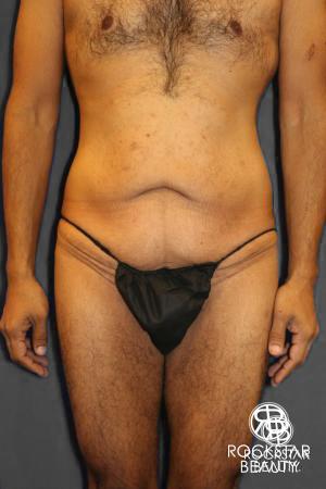 Body Lift: Patient 1 - Before Image 1