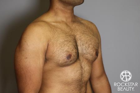 Liposuction: Patient 16 - Before Image 4