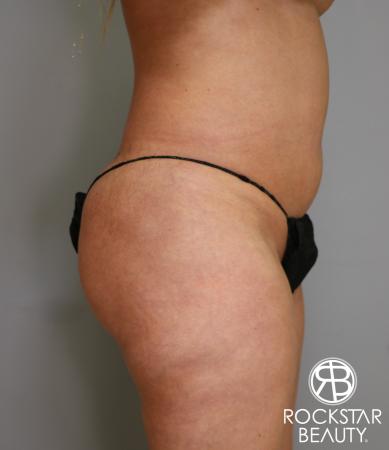 Liposuction: Patient 7 - Before 3