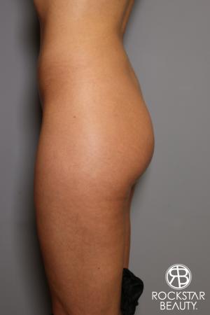 Brazilian Butt Lift: Patient 5 - Before Image 2