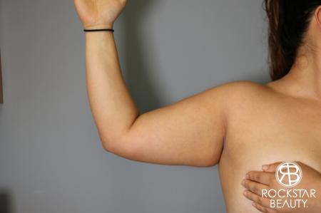 Liposuction: Patient 12 - Before Image 1