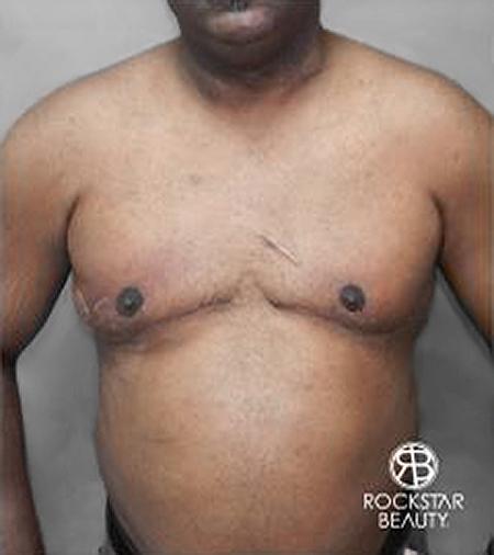 Gynecomastia: Patient 2 - After 1