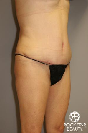 Tummy Tuck: Patient 1 - After Image 2