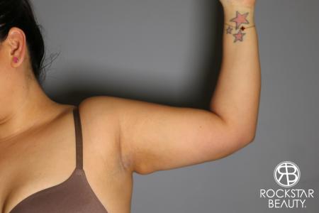 Liposuction: Patient 12 - After Image 2