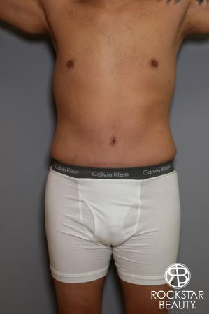 Tummy Tuck: Patient 5 - After Image 2