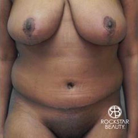 Tummy Tuck: Patient 9 - After 1