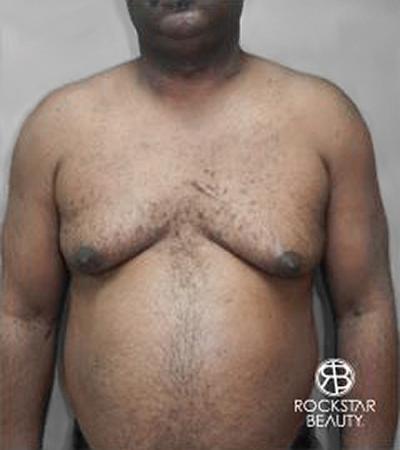 Gynecomastia: Patient 2 - Before Image 1