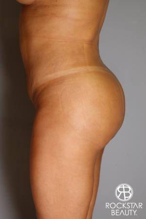Brazilian Butt Lift: Patient 12 - After Image 4