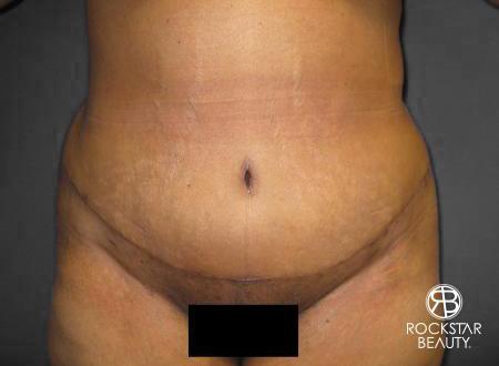 Tummy Tuck: Patient 8 - After 1