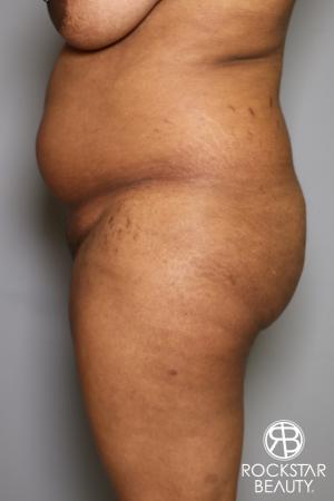 Brazilian Butt Lift: Patient 13 - Before Image 3