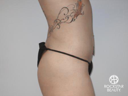 SmartLipo®: Patient 3 - After Image 2