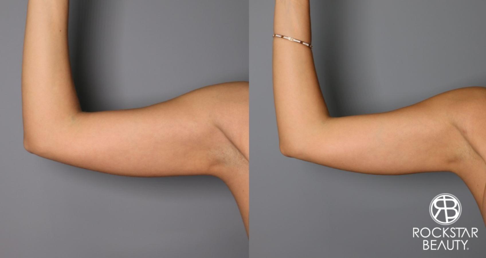 Liposuction: Patient 27 - Before and After 1