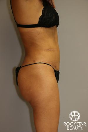Liposuction: Patient 3 - After Image 3