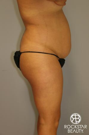 Brazilian Butt Lift: Patient 1 - Before Image 3
