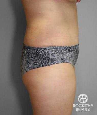 Tummy Tuck: Patient 10 - After 3
