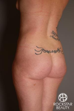 Brazilian Butt Lift: Patient 7 - Before Image 4