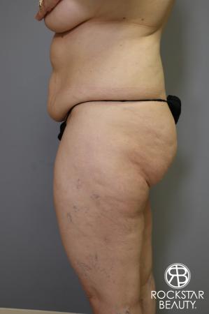 Tummy Tuck: Patient 4 - Before and After Image 5