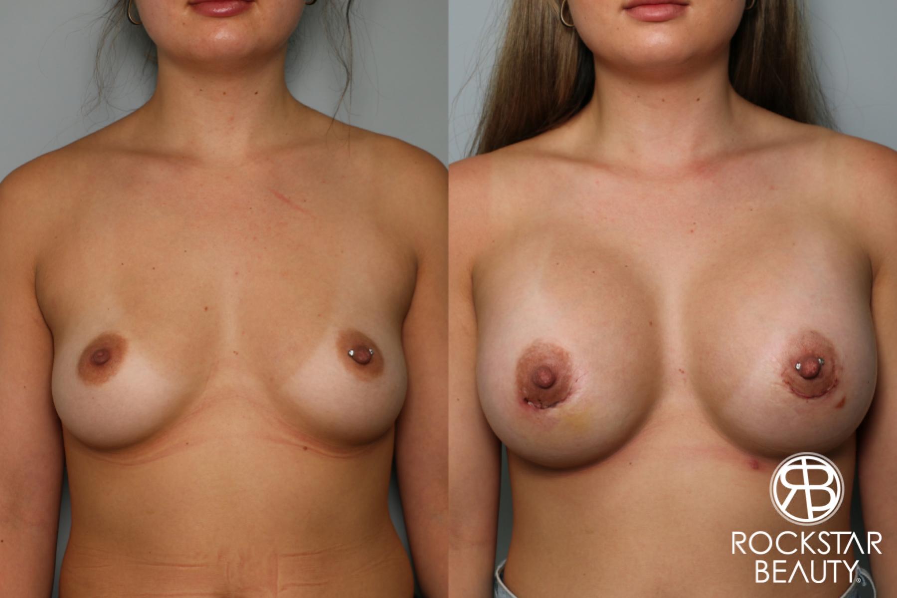 Breast Augmentation: Patient 36 - Before and After 1