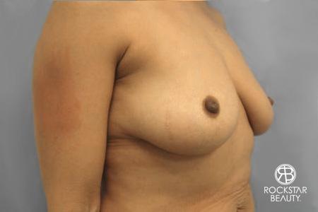 Combo Procedures - Breast: Patient 1 - Before 3