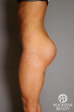 Butt Augmentation: Patient 3 - After Image 3