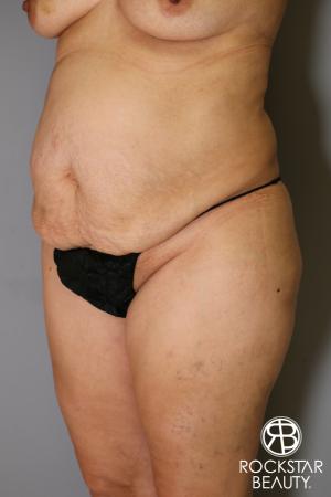 Tummy Tuck: Patient 13 - Before Image 3