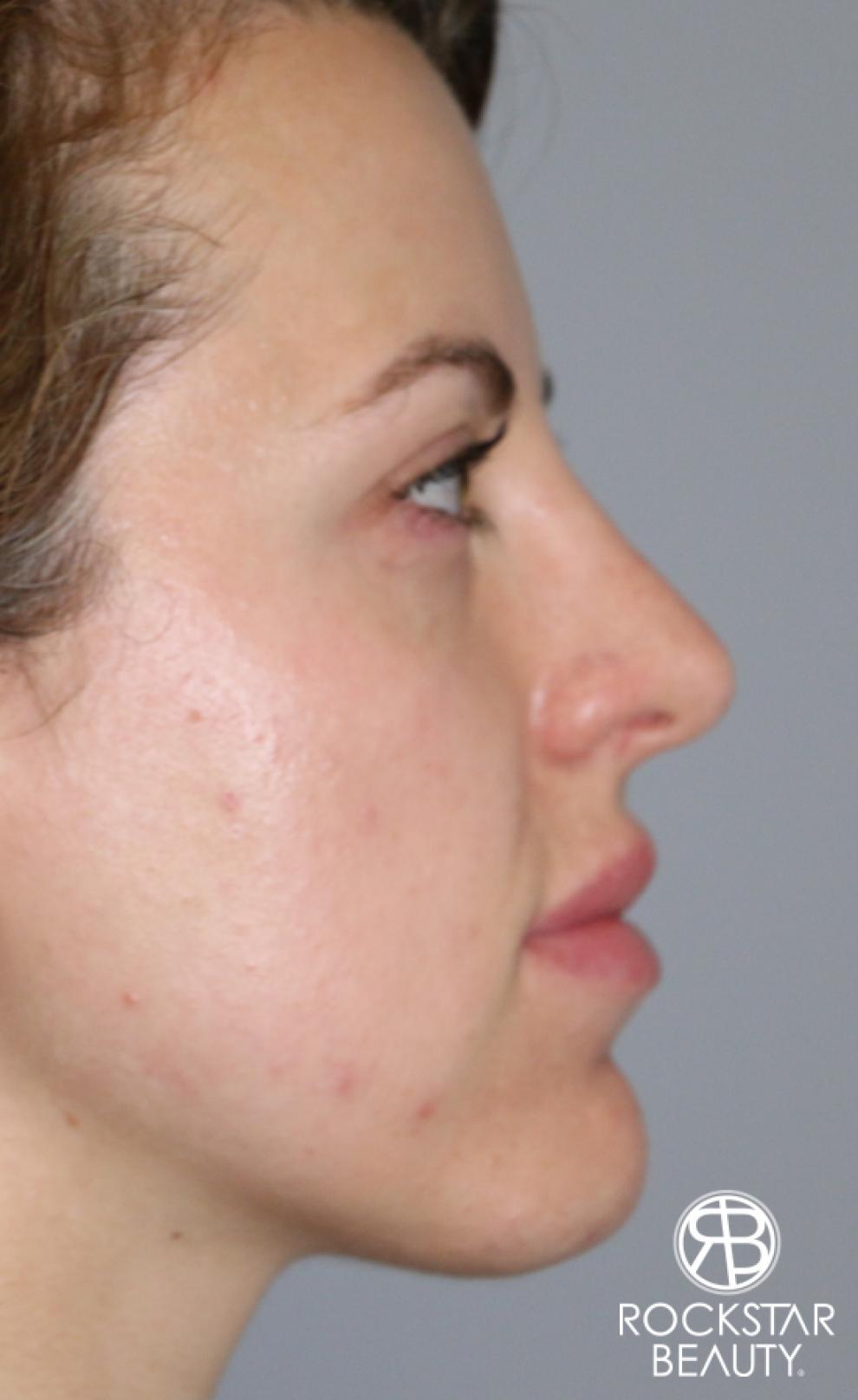 Rhinoplasty: Patient 1 - After 2