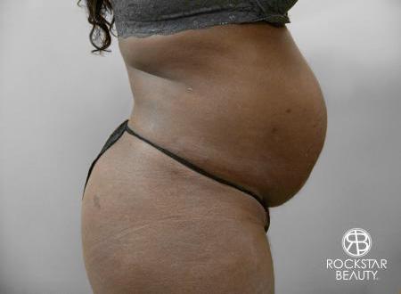 Tummy Tuck: Patient 7 - Before and After 2