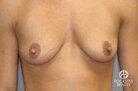 Breast Augmentation: Patient 8 - Before 1