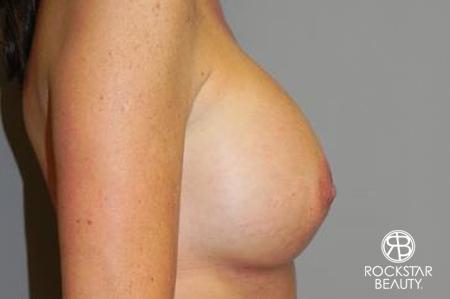 Breast Augmentation: Patient 5 - After 3