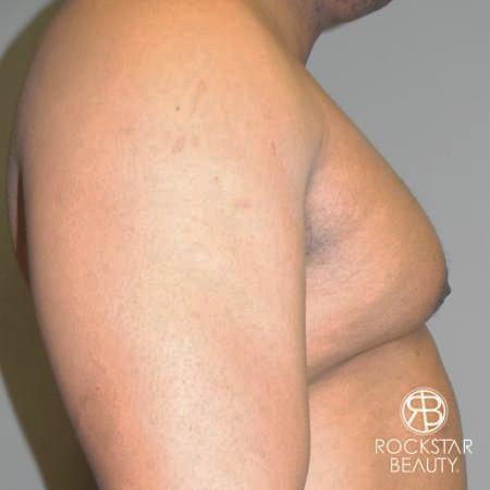 Gynecomastia: Patient 1 - Before and After 3