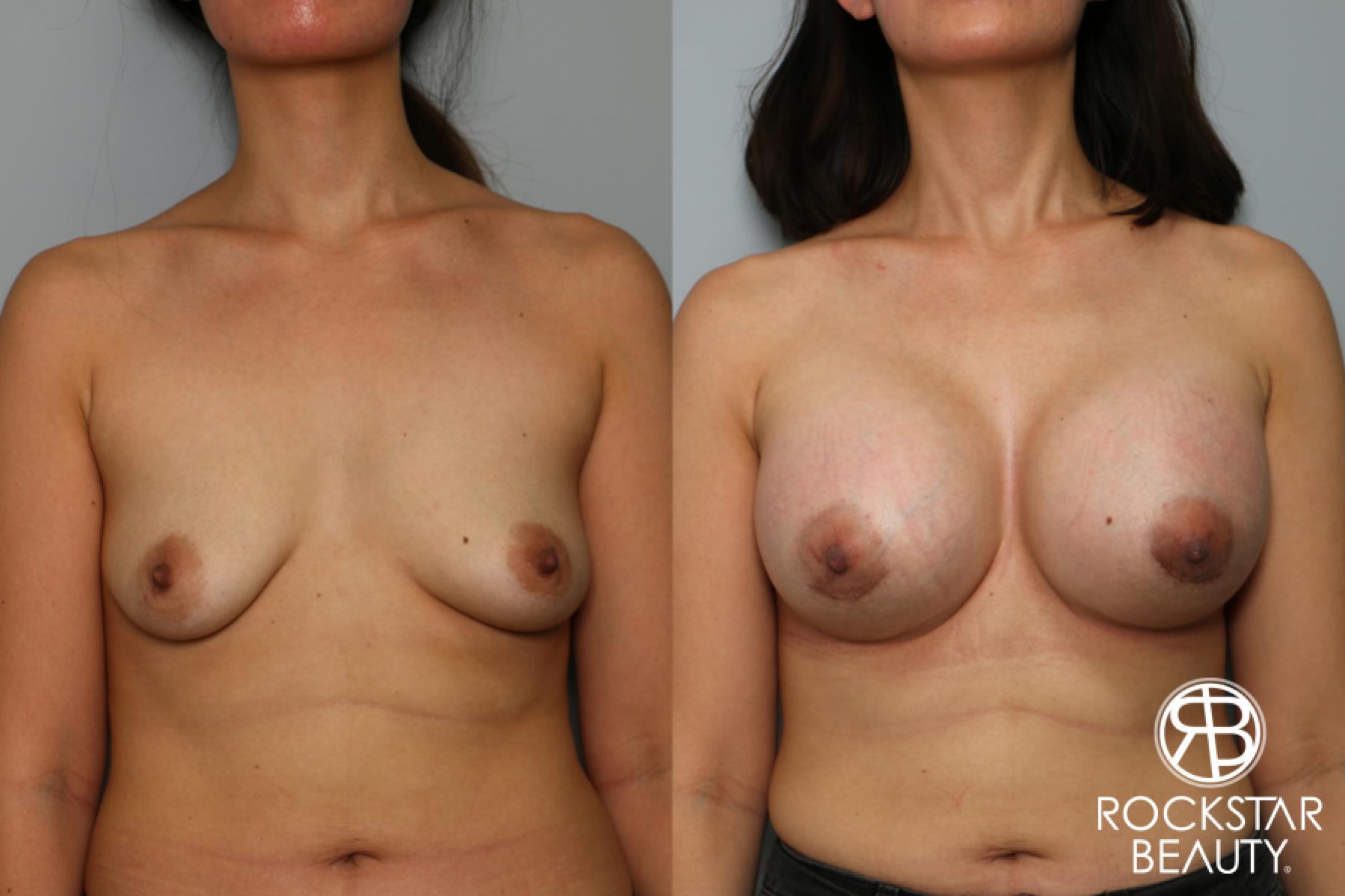Breast Augmentation: Patient 46 - Before and After 1