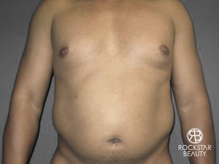 Liposuction: Patient 10 - Before 