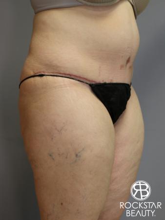 Tummy Tuck: Patient 4 - After Image 2