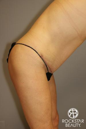 Tummy Tuck: Patient 1 - After Image 4