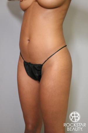 Liposuction: Patient 1 - Before and After Image 5