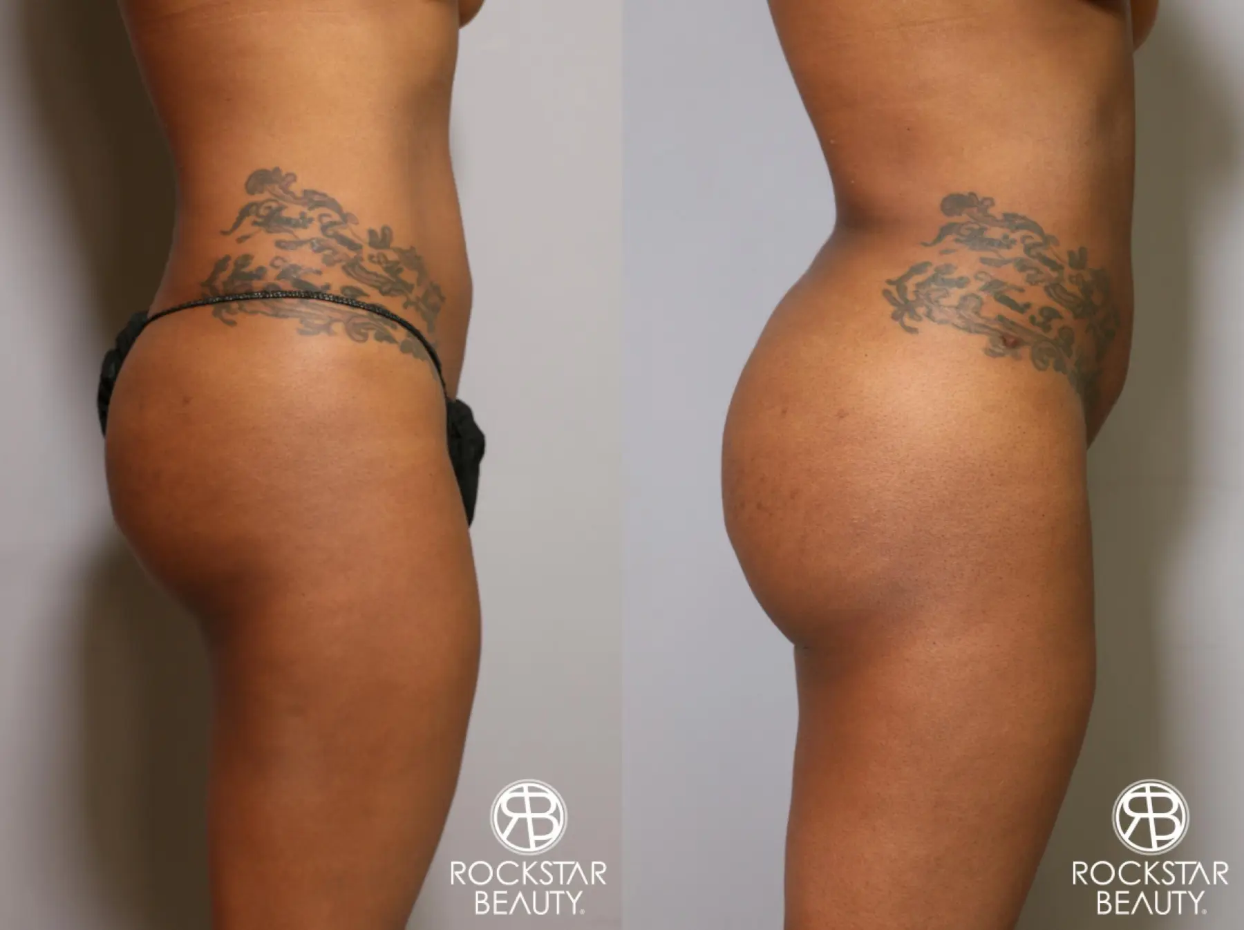 Brazilian Butt Lift: Patient 10 - Before and After 3