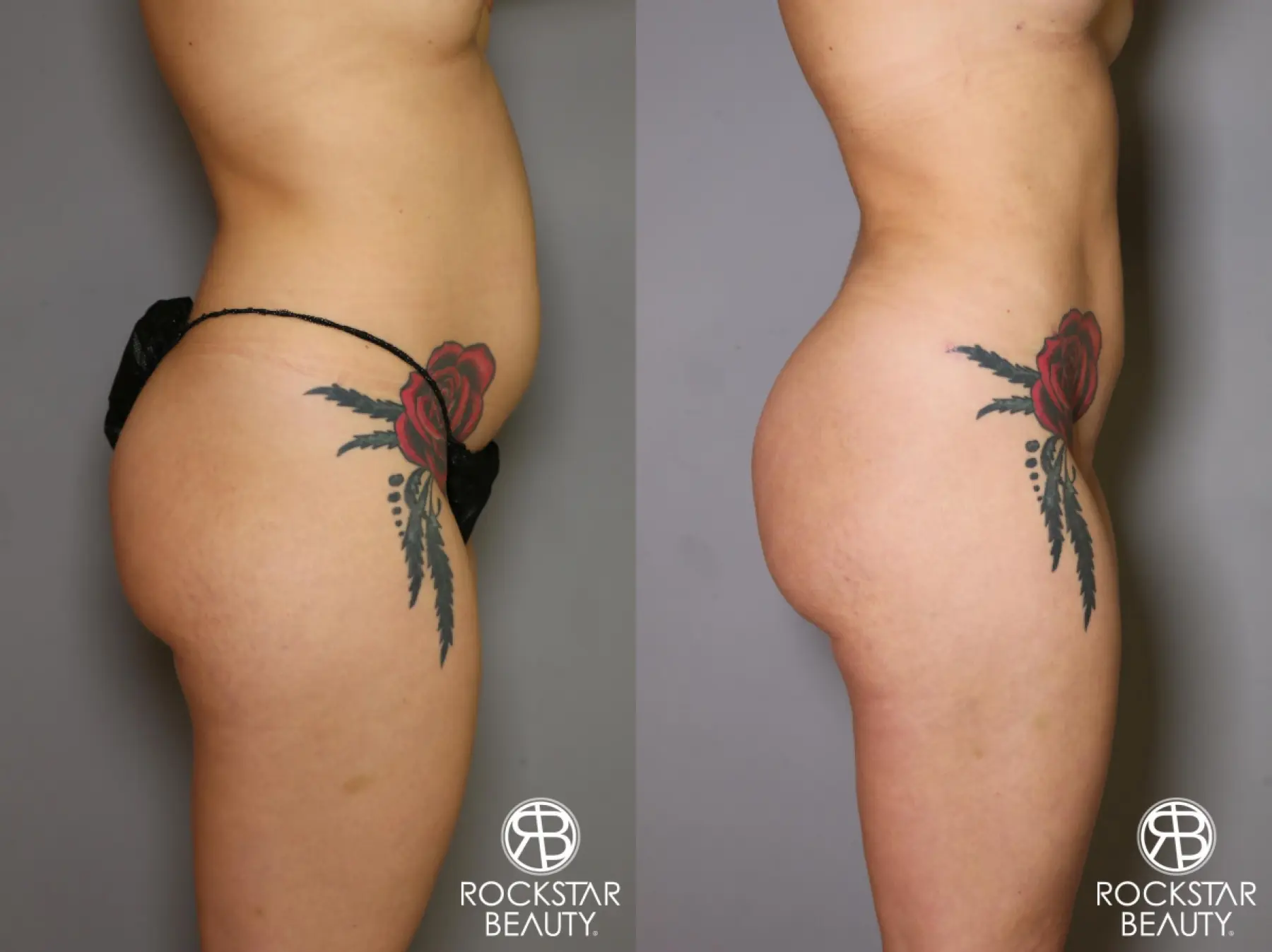 Brazilian Butt Lift: Patient 18 - Before and After 3